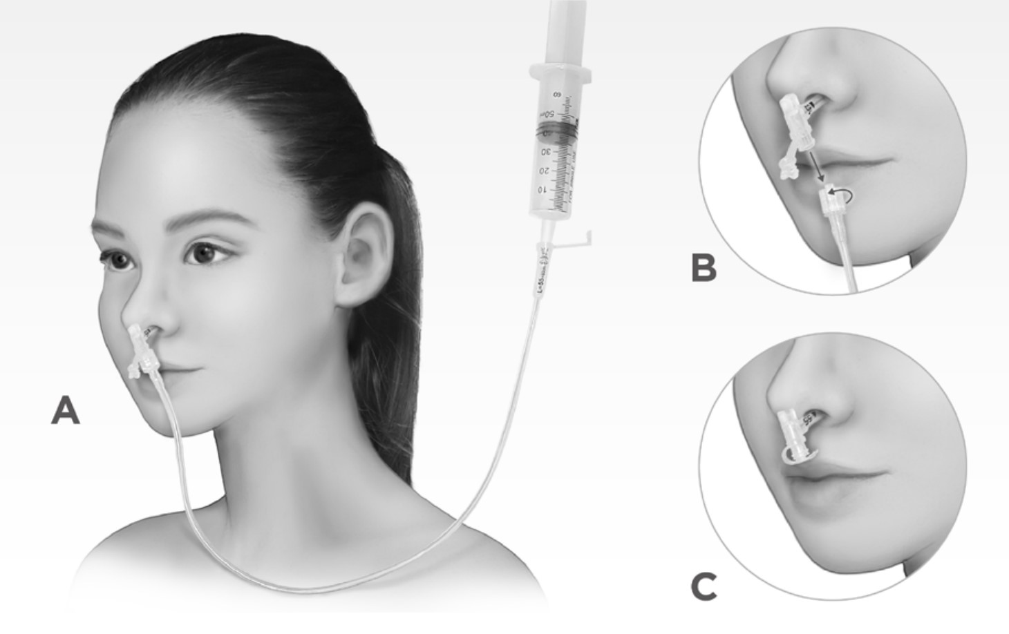 Levin Tube (Detachable)